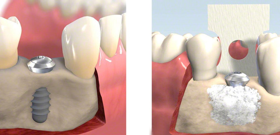 Bone Grafting
