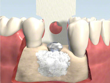 Bone Grafting