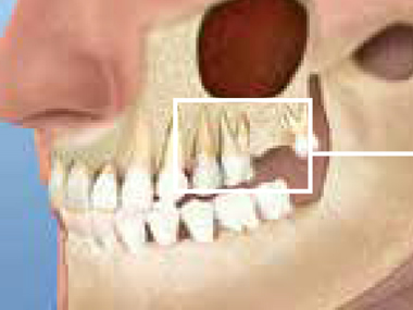 SInus Lift Floor Elevation